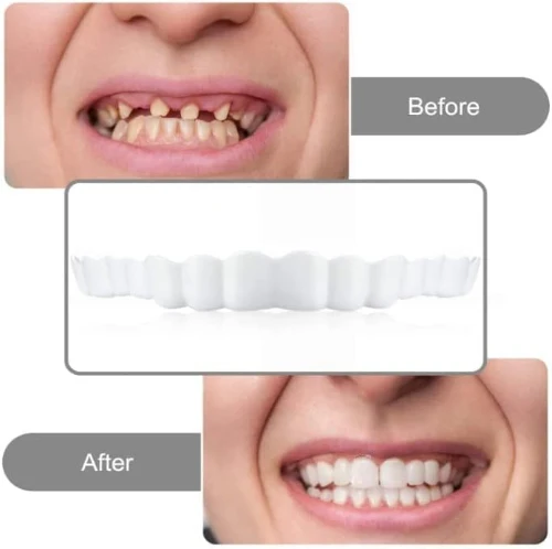 Snap On Smile - Osmeh za Tren